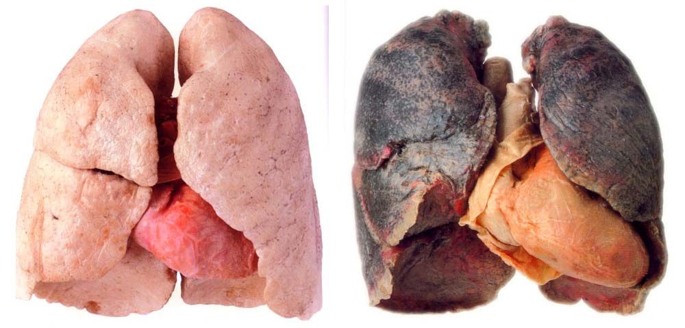 Is &quot;smokers lungs&quot; a lie? - ECHEMI